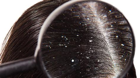 Balakubak (Dandruff) .